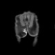 Perianal fistulae, Crohn's disease: MRI - Magnetic Resonance Imaging